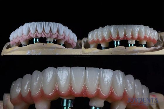 شراء مجموعة زرع أسنان متعددة من 10 ملم في مرحلتين للتاج الاصطناعي التصنيع عبر الإنترنت