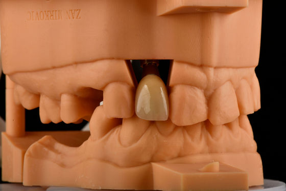 شراء النسخة السينية الداخلية 3.0 ملم العمق 1.5 ملم الطول واحد تيتانيوم استبدال زرع الأسنان التصنيع عبر الإنترنت