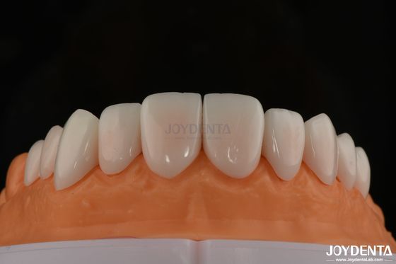 شراء A1-A4 Ips Emax Press البورسلين القشرة الأسنانية المقاومة للبقع الشكل القابل للتخصيص التصنيع عبر الإنترنت