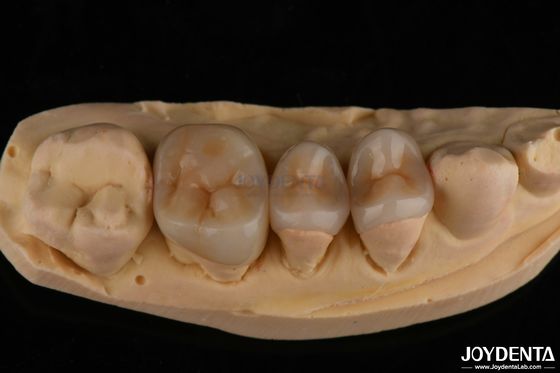 شراء ظاهرة طبيعية Emax Inlay Onlay استعادة الأسنان طويلة الأمد 0.5mm 1mm 1.5mm سميكة التصنيع عبر الإنترنت
