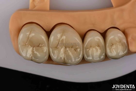 شراء تاج الأسنان من الذهب والقلع المعدني الممتاز من أجل زيادة المتانة التصنيع عبر الإنترنت