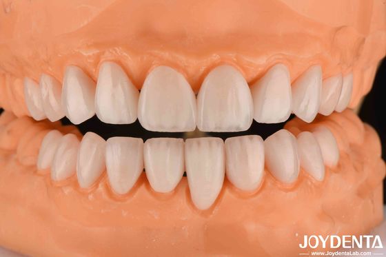 شراء القشرة السيراميكية Emax 0.3-0.5mm سمك القشرة البورسلينية التجميلية طويلة الأمد التصنيع عبر الإنترنت