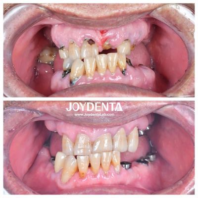 شراء المقاومة للارتداء و التشوهات التاج الأسنان الزركونيا دائمة و مناسبة لاستعادة الخلفية و الأمامية التصنيع عبر الإنترنت