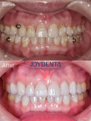 شراء البورسلين القشرة استعادة الفم التصنيع عبر الإنترنت