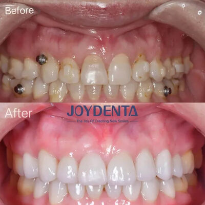 شراء أظافر الأسنان المفقودة. التصنيع عبر الإنترنت