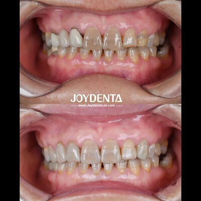 شراء زركونيا الأسنان خفيفة الوزن لتجربة مريض مثالية لون طبيعي التصنيع عبر الإنترنت
