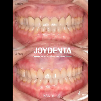 شراء الزركونيا الأسنانية للأنسجة الفموية الآمنة والتوافق CAD / CAM التصنيع عبر الإنترنت