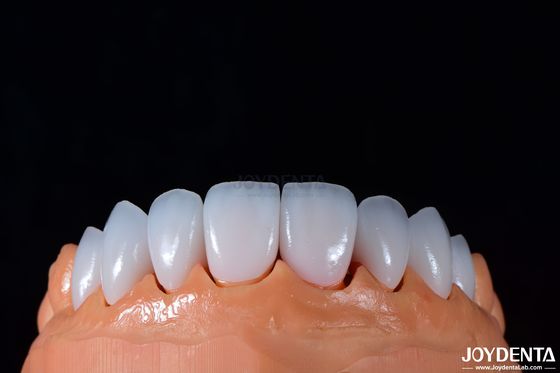 0.3-0.5 ملم سمك Emax البورسلين القشرة لأسنان التجميل عالية اللمعان