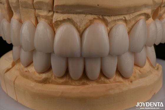 0.3 ملم سمك Ips Emax Veneers Veneers السيراميكية