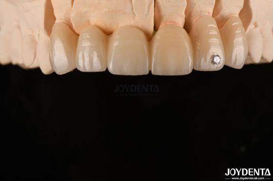CAD / CAM طحن زيركونيا طبقة أسنان لتاج واحد 0.3-0.5mm سمك الطبقة
