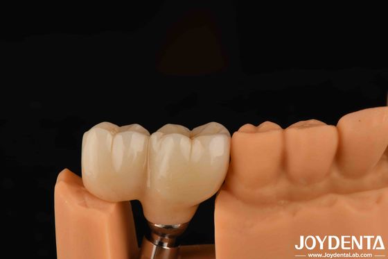 نوع الخيوط على شكل V المنتهية Abutments التوافق مع جميع أنظمة الزرع الرئيسية