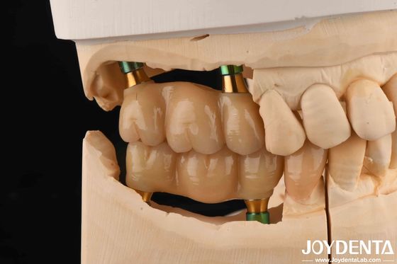 4.5 ملم ارتفاع ممزقة الداخلية هيكس زراعة الأسنان Abutments شكل V المسمار المحافظة