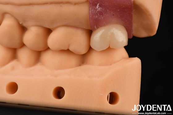 4.1mm V الشكل الخيوط التيتانيوم Abutments مع اتصال هيكس الداخلية