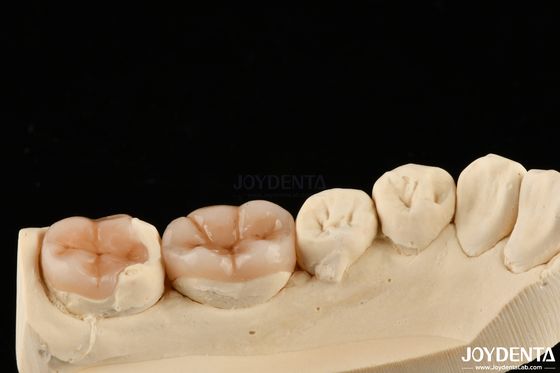 إعادة تثبيت الأسنان الطبيعية ذات المظهر الطبيعي