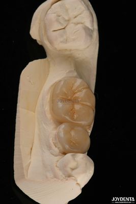 إيماكس الأسنان المضمنات والضمادات المقاومة للكسر 1.5 ملم ضوء شفاف منخفض