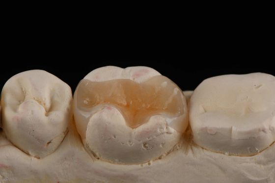 E Max المواد المضمنة والمتضمنة في طب الأسنان الترميم الجمالي