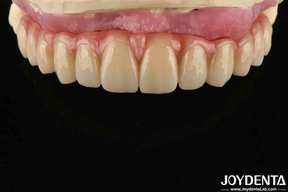 مريحة ارتداء التيتانيوم مالونغ الجسر الهجينة الأسنان قابلة للتعديل التصميم خفيفة الوزن