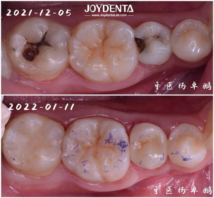 استمرارية عالية إدخال استعادة الأسنان للأسنان المتضررة