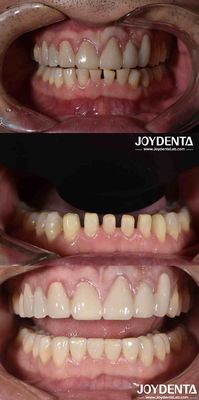 الشكل الطبيعي التجميلي طب الأسنان البورسلين ، طب الأسنان التجميلي البورسلين