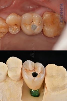 زراعة الأسنان ذات القوس الكامل من التيتانيوم منصة استصلاحية 4.1 ملم لمتانة استثنائية