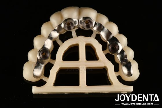الفضة النهاية المخصصة Abutments والشرائط الملائمة بدقة المسمار المحافظة أو الاسمنت المحافظة