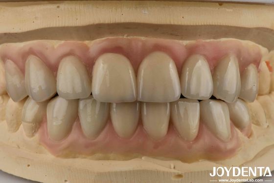 الشفافية العالية Emax التجميل طب الأسنان القشرة الجمالية العالية رقيقة للغاية