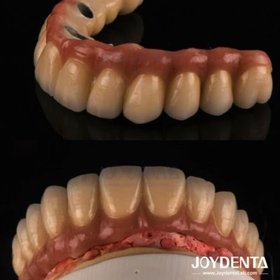 صب و طحن PFM تاج الأسنان ، استعادة الأسنان