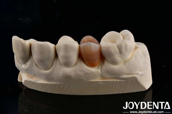 متوافق بيولوجيًا ومظهر طبيعي متعدد الطبقات الزركونية الكاملة مع جماليات