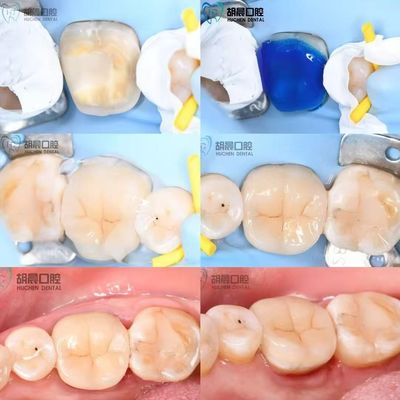 تجربة دقة طبقة الأسنان السعرية والبيضاء لتناسب مثالي