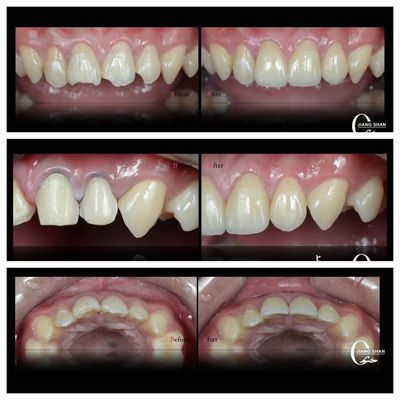 القشرة الطبيعية للأسنان لابتسامة طبيعية وجميلة
