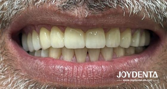 الأسنان الصناعية التي تحاكي الأسنان الطبيعية