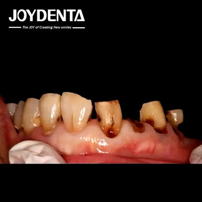 تاج زيركونيا عالي الجودة لمختبرات الأسنان العالمية