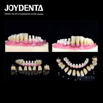 زراعة أسنان متعددة داخلية للاتصال الداخلي لاستعادة القوس الكامل