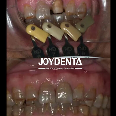 التاج الزركونيا الشفافية تقنية التدرج المتعددة الطبقات