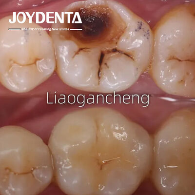 البورسلين الأسنان المضخة استعادة للبالغين والأطفال الأداء الاستثنائي