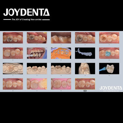 البالغين الأطفال البورسلين السيراميكية الأسنان المضخة استعادة للأسنان المتضررة