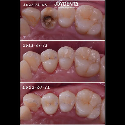 حشوة بورسلين للأسنان تناسب بدقة ترميم الأسنان التالفة
